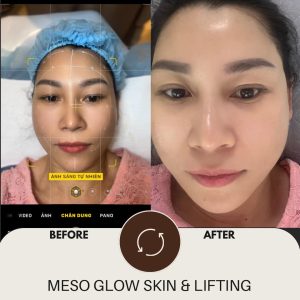 Mesotherapy Phục Hồi Da