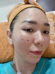 Dịch Vụ GREEN HERBAL PEEL – Giải Pháp Hoàn Hảo Cho Làn Da Khỏe Mạnh