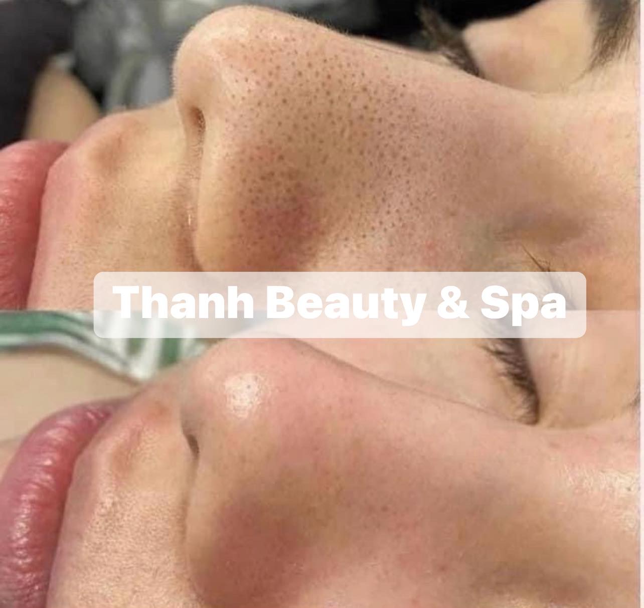 4 Tác Nhân Gây Mụn Mà Bạn Cần Biết – Phương Pháp Điều Trị Hiệu Quả Tại Thanh Beauty & Spa