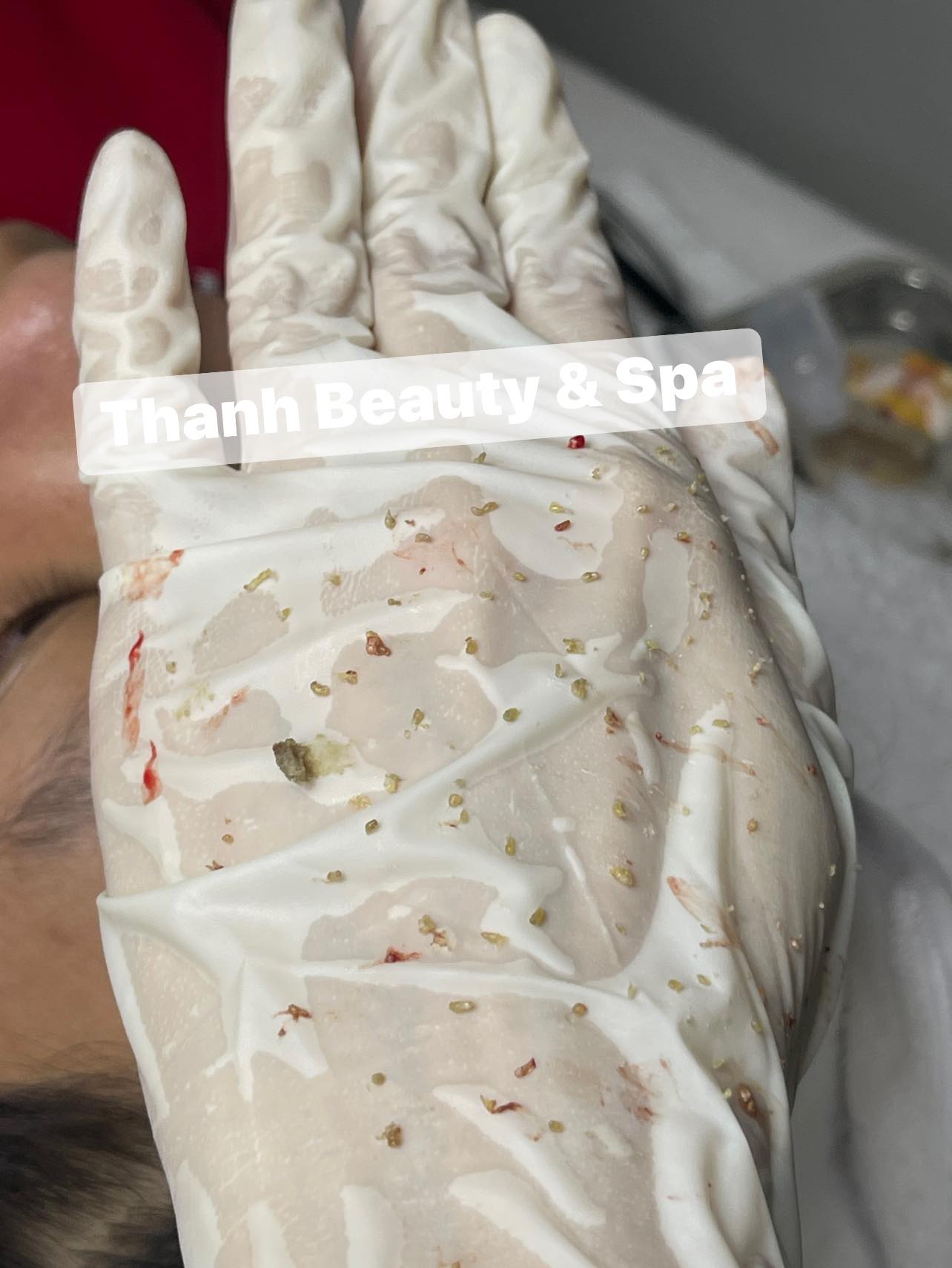 4 Tác Nhân Gây Mụn Mà Bạn Cần Biết – Phương Pháp Điều Trị Hiệu Quả Tại Thanh Beauty & Spa