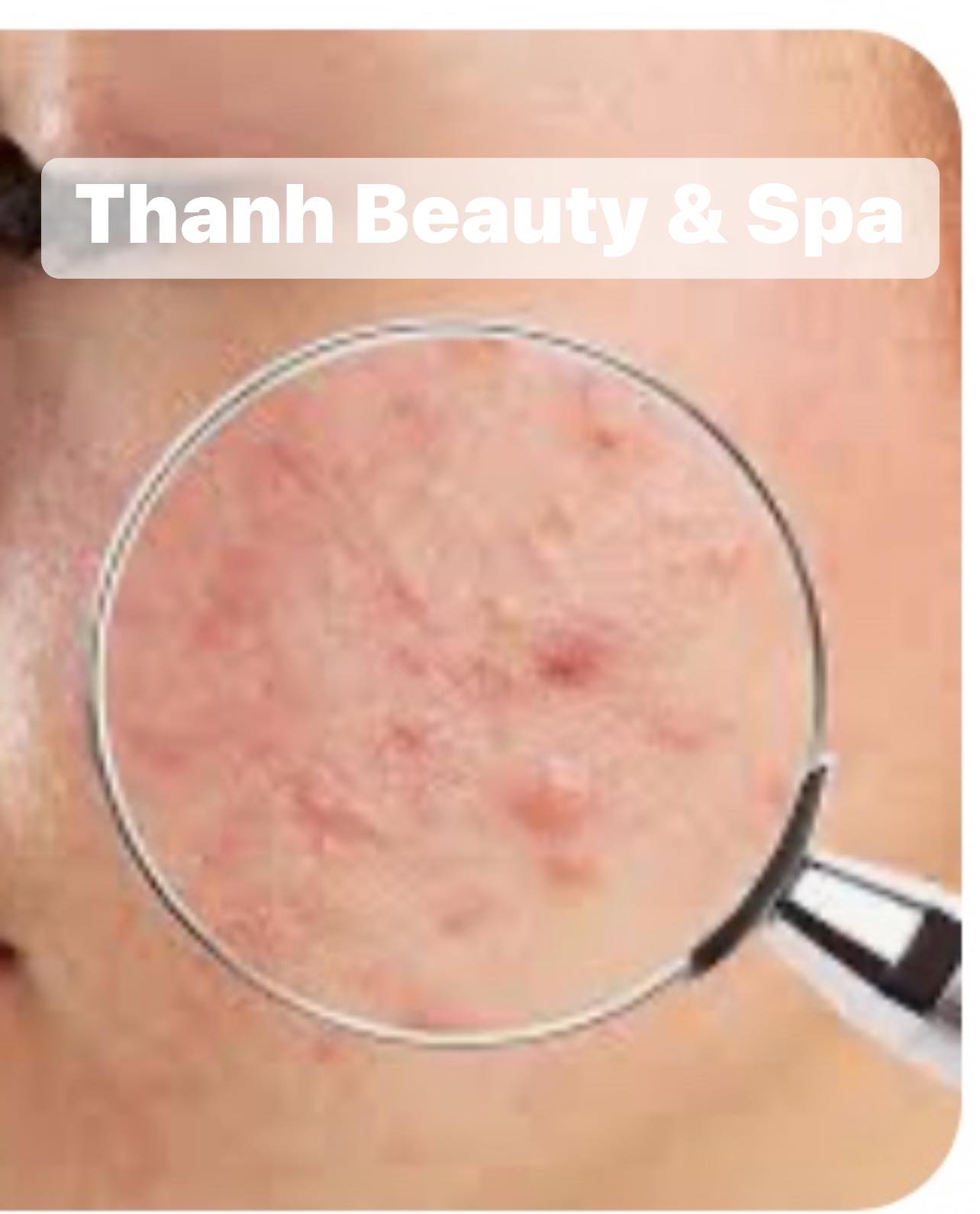 4 Tác Nhân Gây Mụn Mà Bạn Cần Biết – Phương Pháp Điều Trị Hiệu Quả Tại Thanh Beauty & Spa