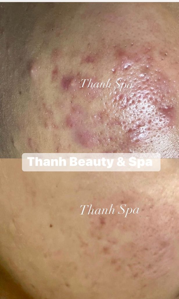 Phục hồi da yếu, da nhiễm Corticoid