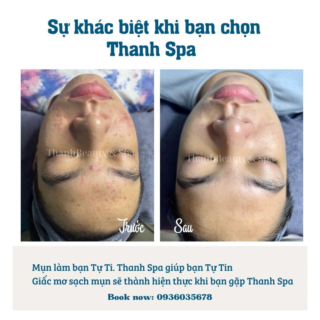 Giải Pháp Toàn Diện Cho Vấn Đề Mụn: Đừng Để Mụn Gây Cản Trở Cuộc Sống Của Bạn!