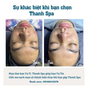 Giải Pháp Toàn Diện Cho Vấn Đề Mụn: Đừng Để Mụn Gây Cản Trở Cuộc Sống Của Bạn!