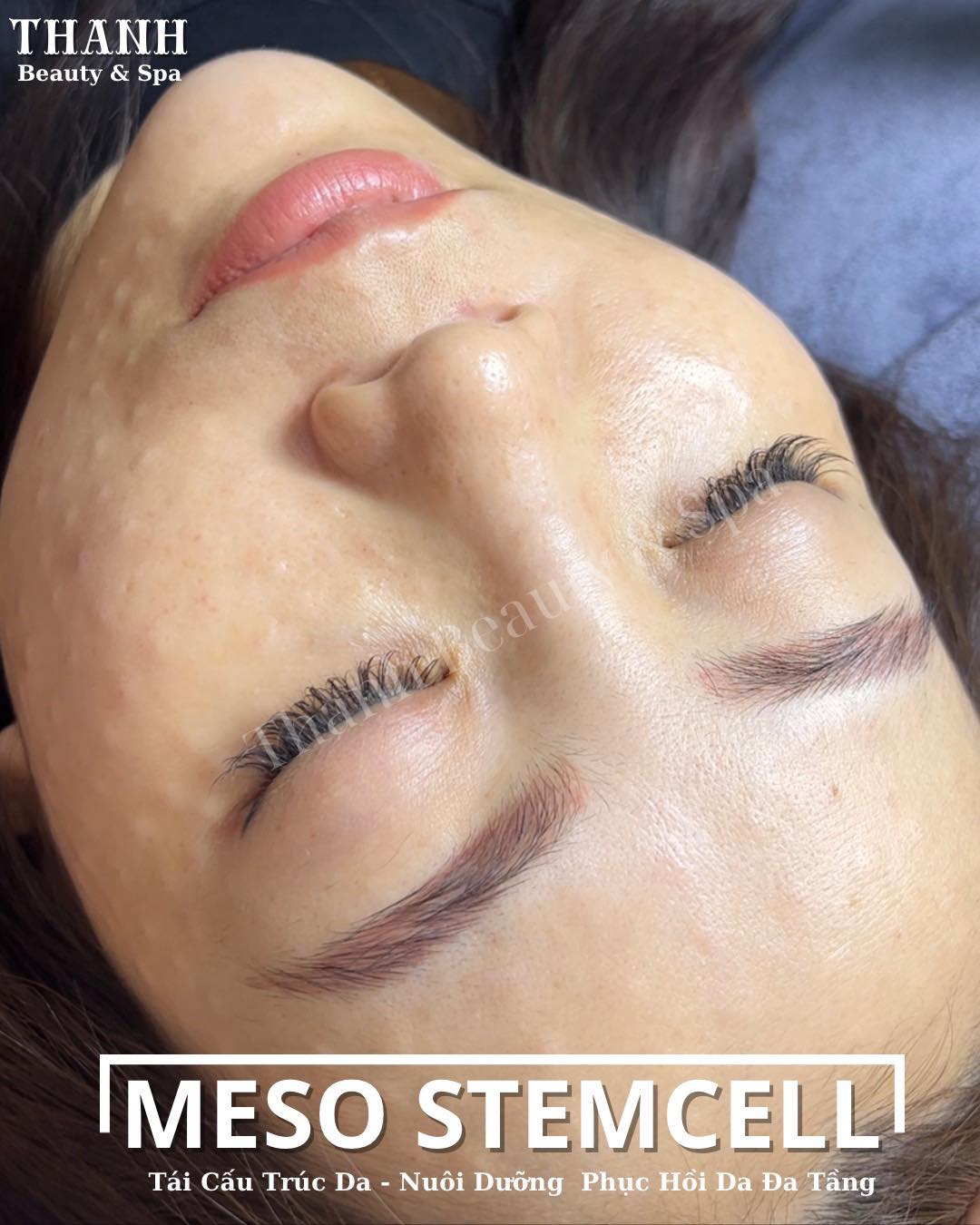 Đánh Bay Nỗi Sợ - Meso Tại Thanh Beauty & Spa: Đến Để Trải Nghiệm Và Thay Đổi!