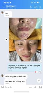 ĐAU ĐẦU VÌ HỆ LỤY CỦA MỤN-SẸO VÀ THÂM