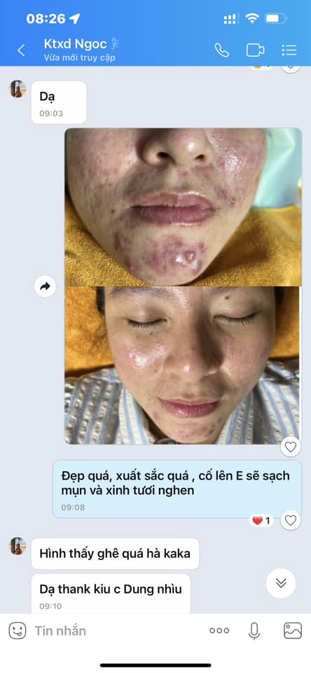 ĐAU ĐẦU VÌ HỆ LỤY CỦA MỤN-SẸO VÀ THÂM
