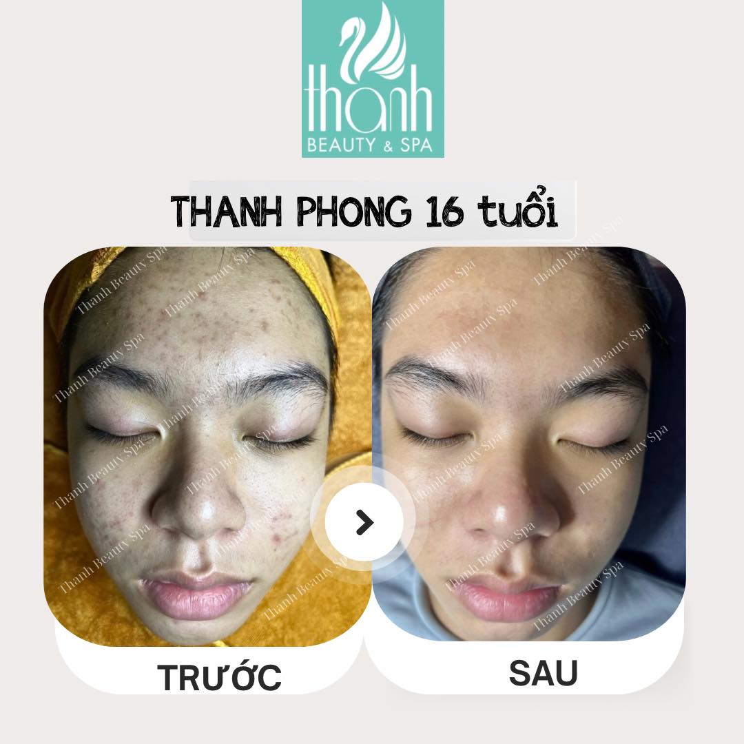 Điều trị mụn tại Thanh Beauty Spa