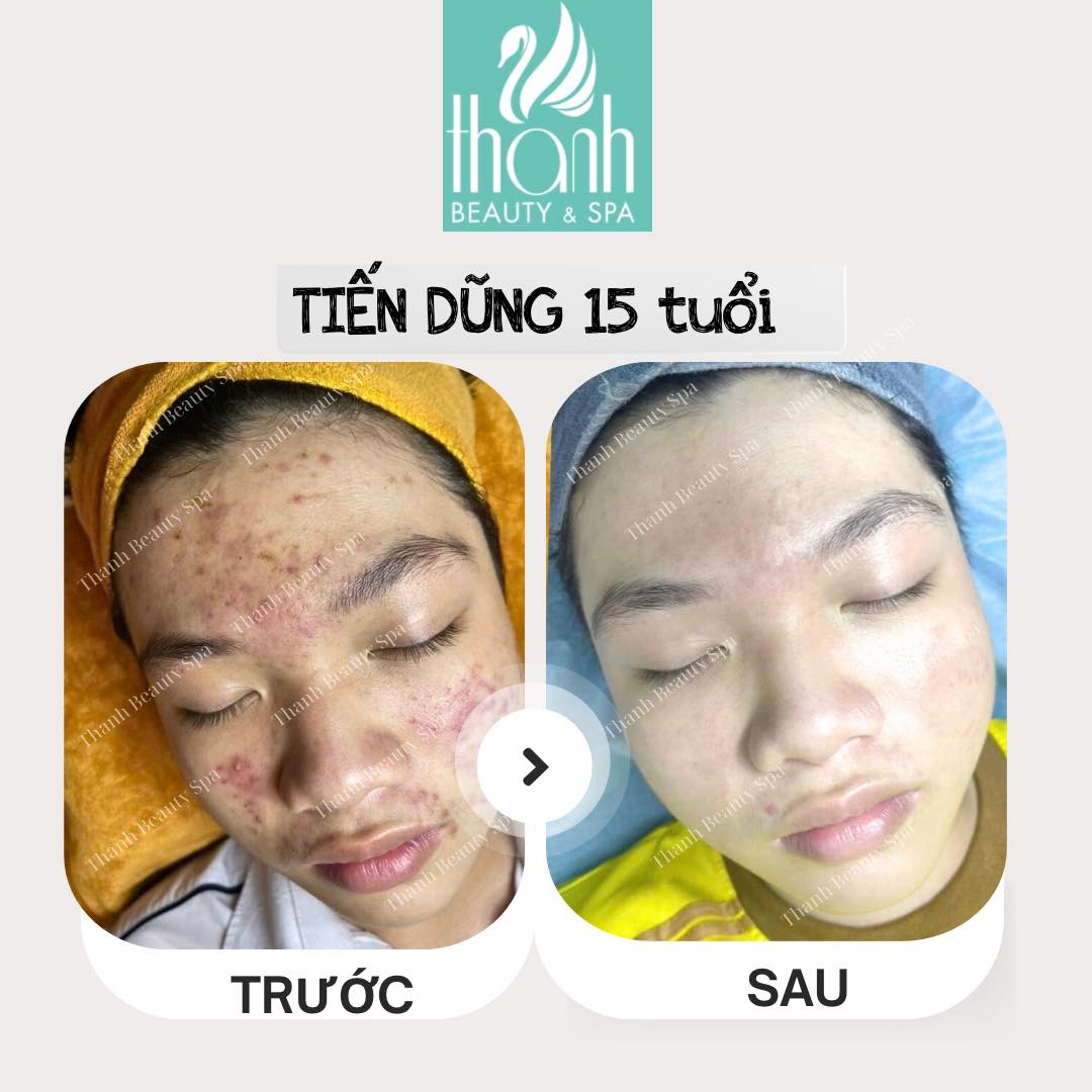 Điều trị mụn tại Thanh Beauty Spa
