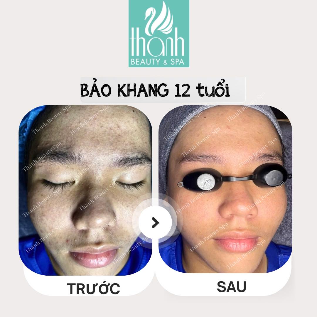Điều trị mụn tại Thanh Beauty Spa