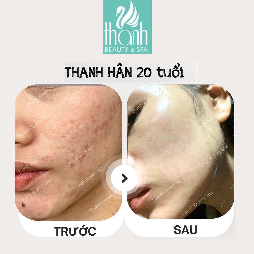 Điều trị mụn tại Thanh Beauty Spa