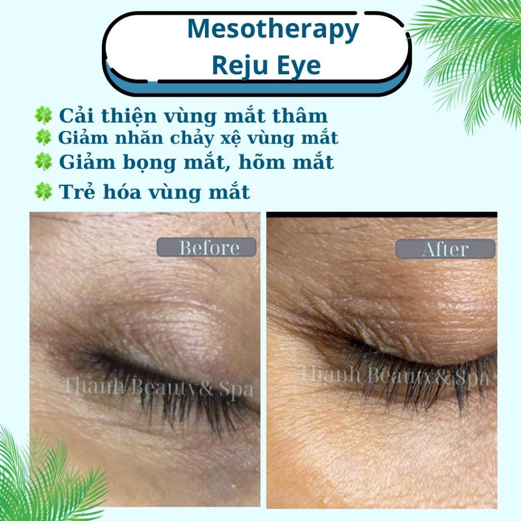 NGĂN NGỪA LÃO HÓA: CÁCH CHĂM SÓC DA VÙNG MẮT HIỆU QUẢ