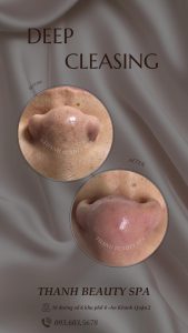 MỤN ĐẦU ĐEN GÂY PHIỀN TOÁI