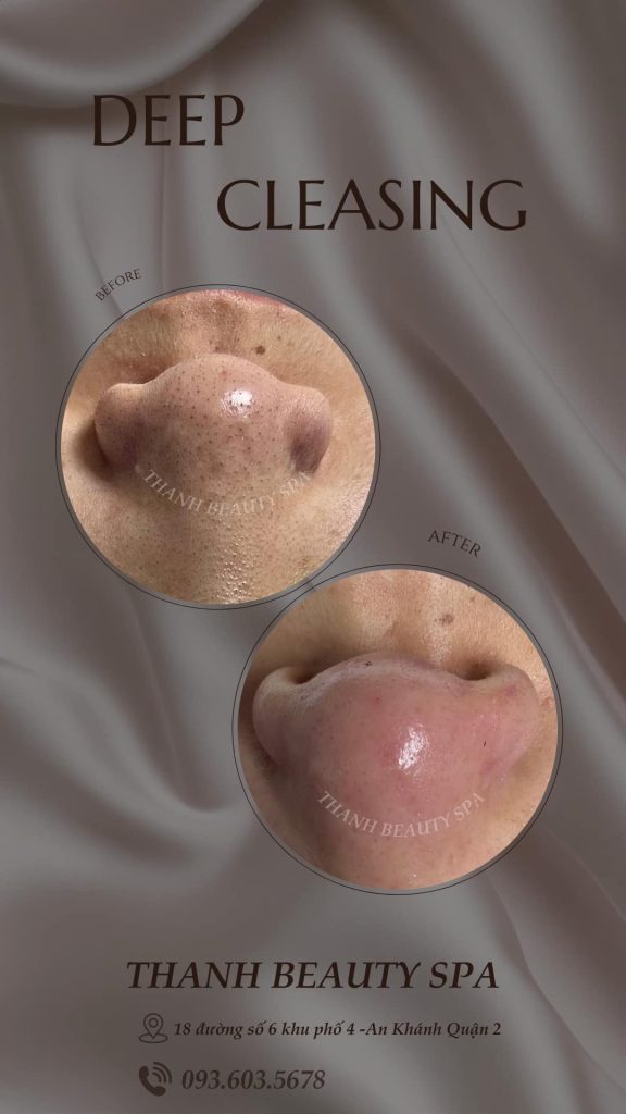 MỤN ĐẦU ĐEN GÂY PHIỀN TOÁI