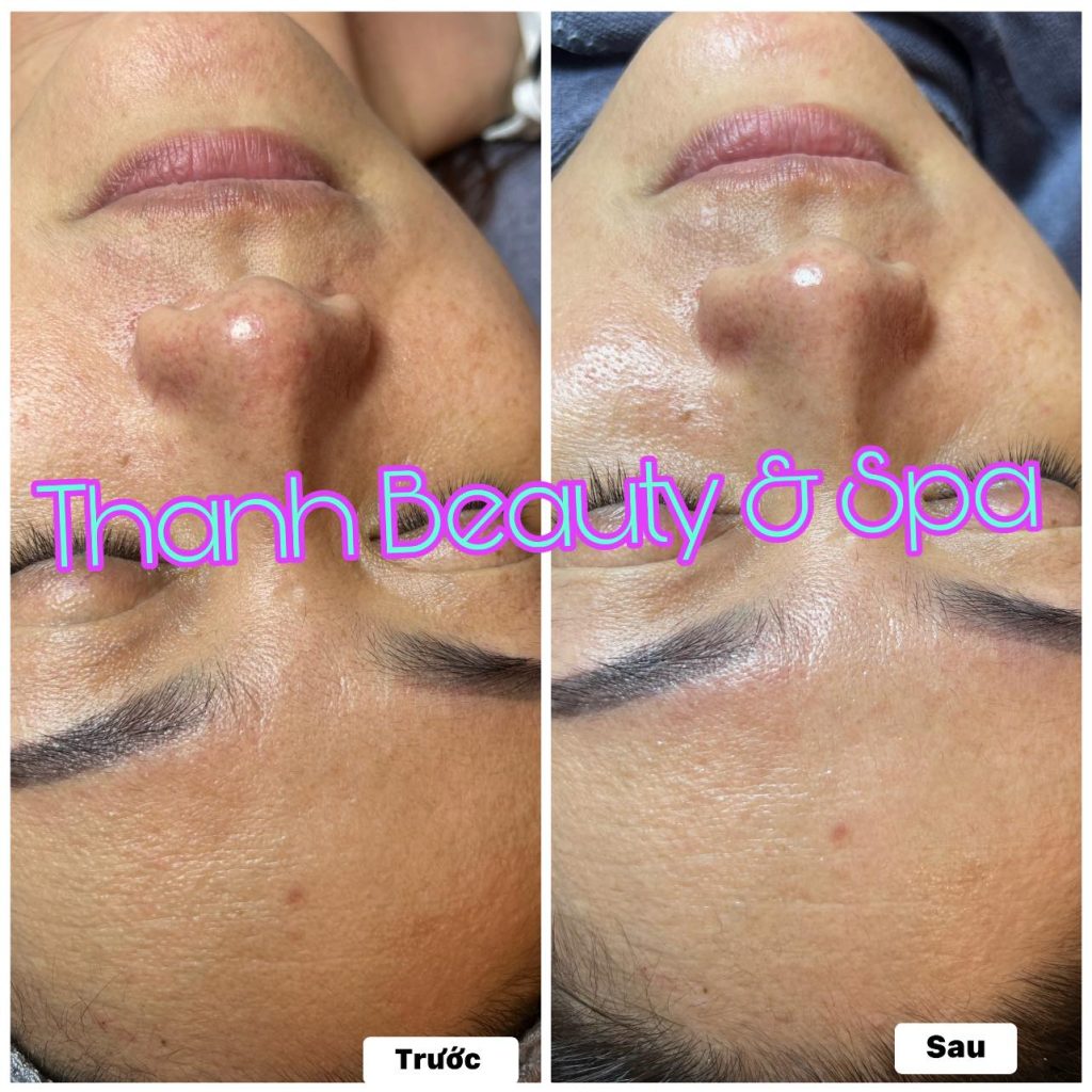 Oxy Fusion Treatment – Khôi Phục Da Mẫn Cảm, Tăng Cường Oxy Cho Làn Da Tươi Mới