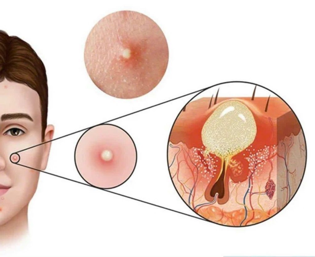 TẠI SAO? Lấy nhân mụn mãi không hết...