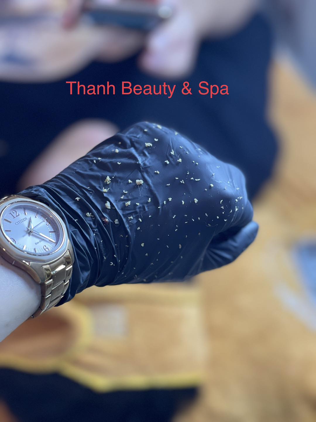 TẠI SAO? Lấy nhân mụn mãi không hết...