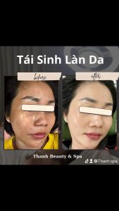 Tái sinh làn da tại Thanh Beauty Spa