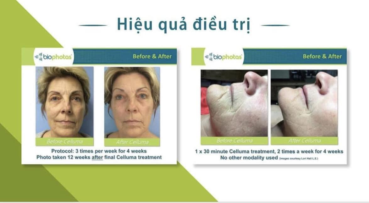 Trải Nghiệm Công Nghệ Trị Liệu Da Đột Phá Với Celluma Tại Thanh Beauty & Spa!