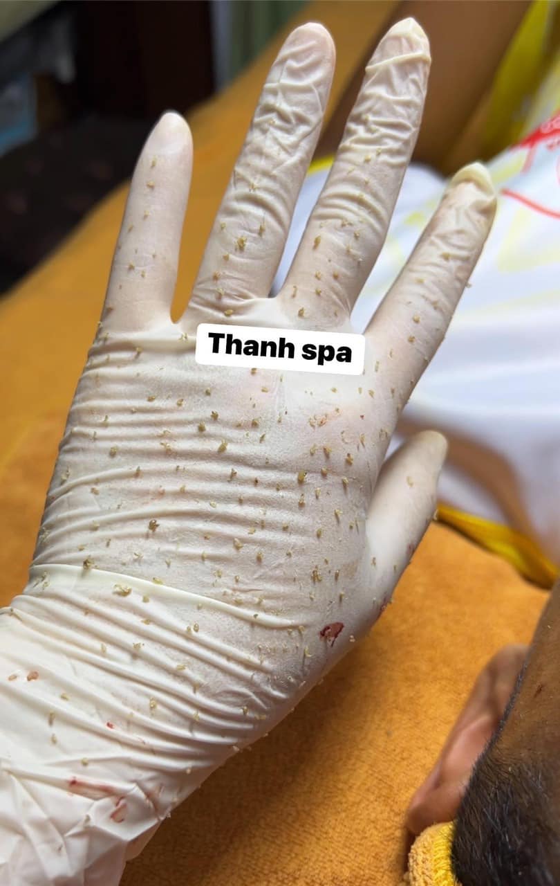 Trải Nghiệm Công Nghệ Trị Liệu Da Đột Phá Với Celluma Tại Thanh Beauty & Spa!